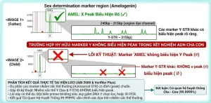Xét nghiệm ADN cha con: Vì sao một marker Y không biểu hiện peak nhưng vẫn xác định quan hệ huyết thống?